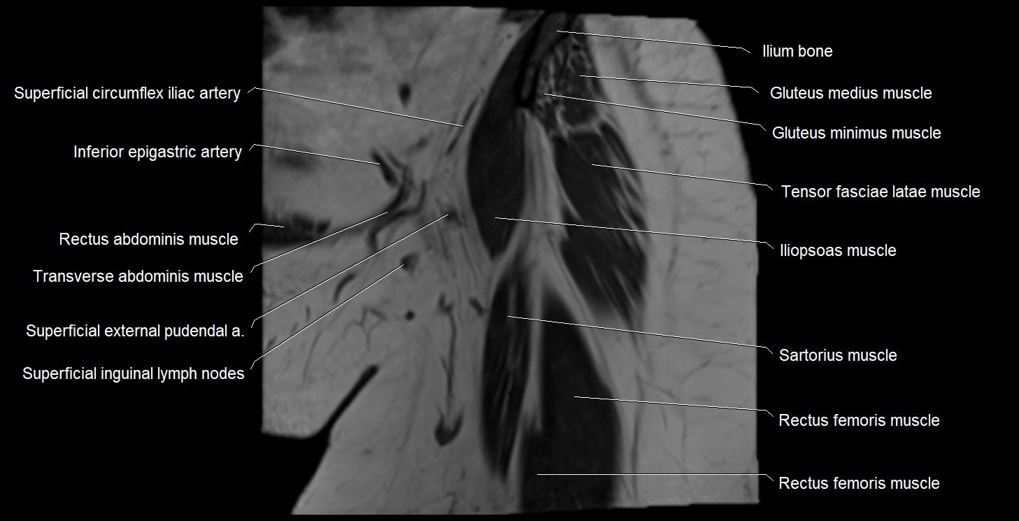 MRI Hip 3T coronal cross sectional anatomy image 5.webp